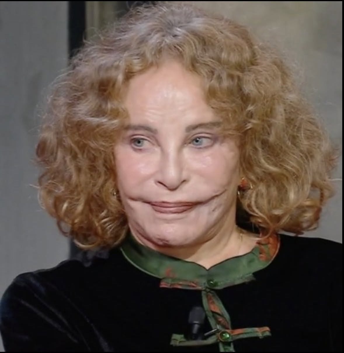 Elle fut un temps considérée comme la plus belle femme du monde — son visage était partout. 👧💫 Mais un accident tragique a tout changé. 💔🤷‍♂️ Aujourd’hui, ses fans sont surpris de constater à quel point son apparence a changé, et rares sont ceux qui la reconnaissent dans la rue. 😮🔍 Pouvez-vous deviner de qui il s’agit ? ➡️ Découvrez son nom et voyez les photos dans les commentaires ! 📸⬇️⬇