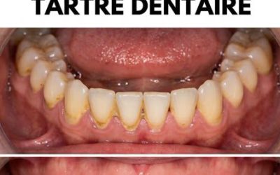 7 astuces pour éliminer les dépôts de tartre sur les dents avec un minimum d’effort. L’article dans les commentaires 👇