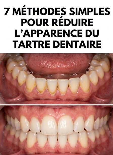 7 astuces pour éliminer les dépôts de tartre sur les dents avec un minimum d’effort. L’article dans les commentaires 👇