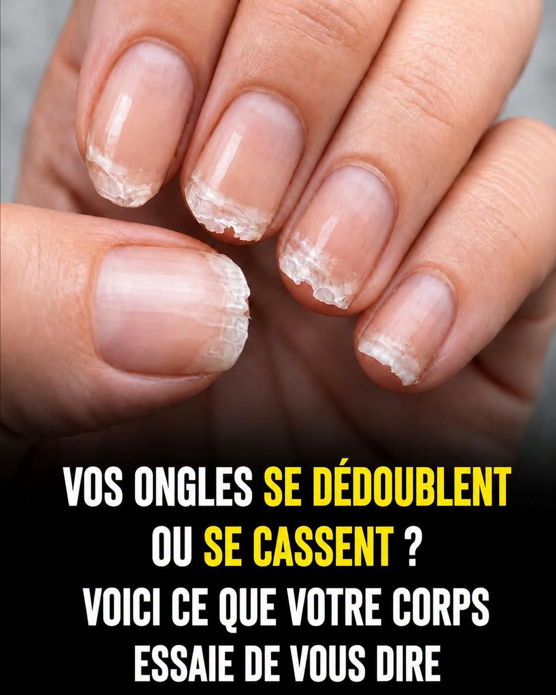 Des ongles cassants ou fragiles peuvent signaler... voir plus